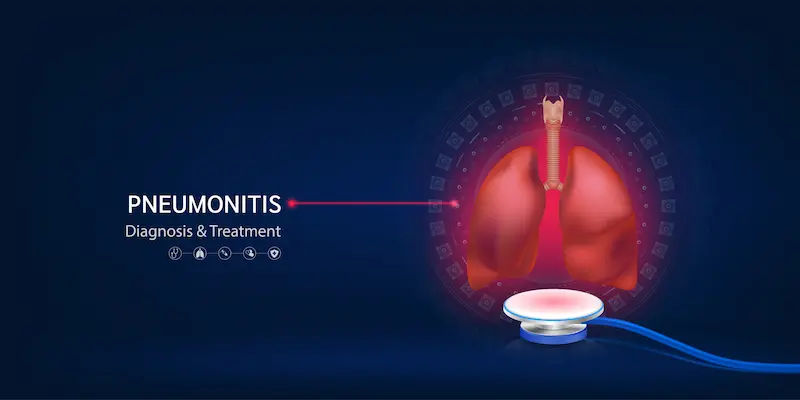Pneumonitis Overview and Treatment Options